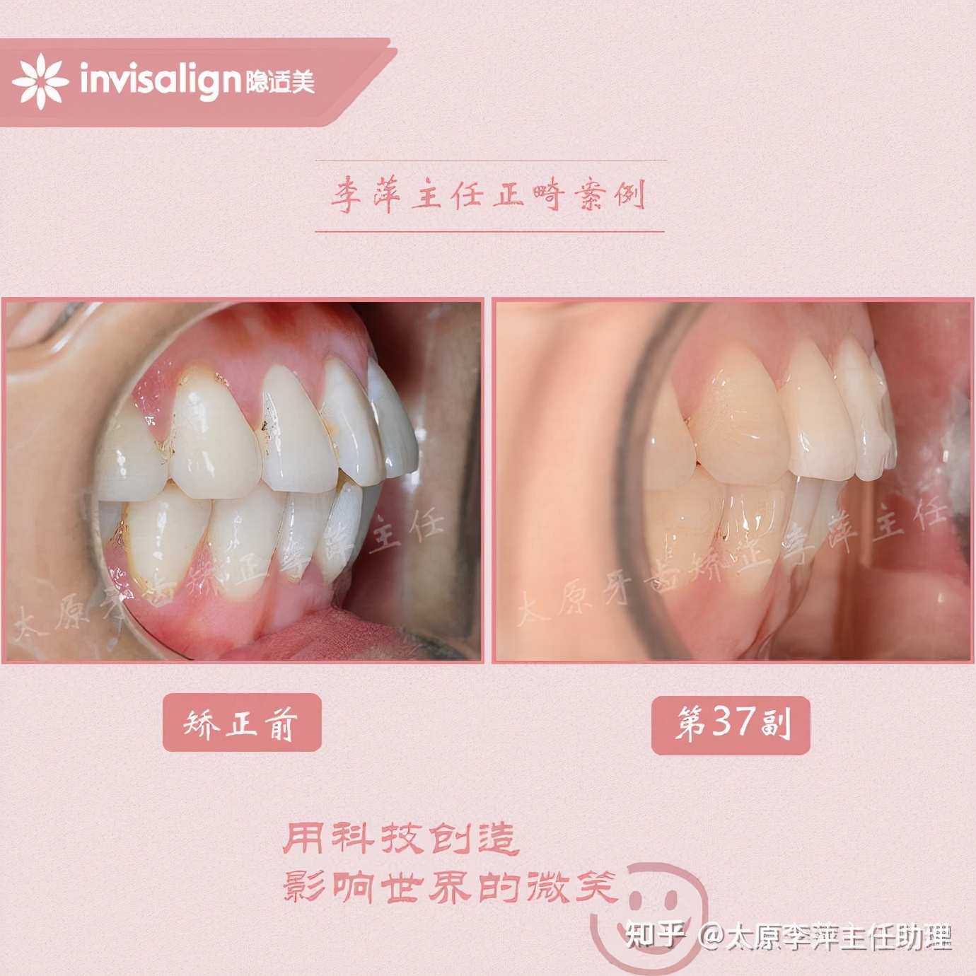 重度拥挤矫正牙齿适合隐形牙套吗,广州成人牙齿矫正推荐隐形牙套