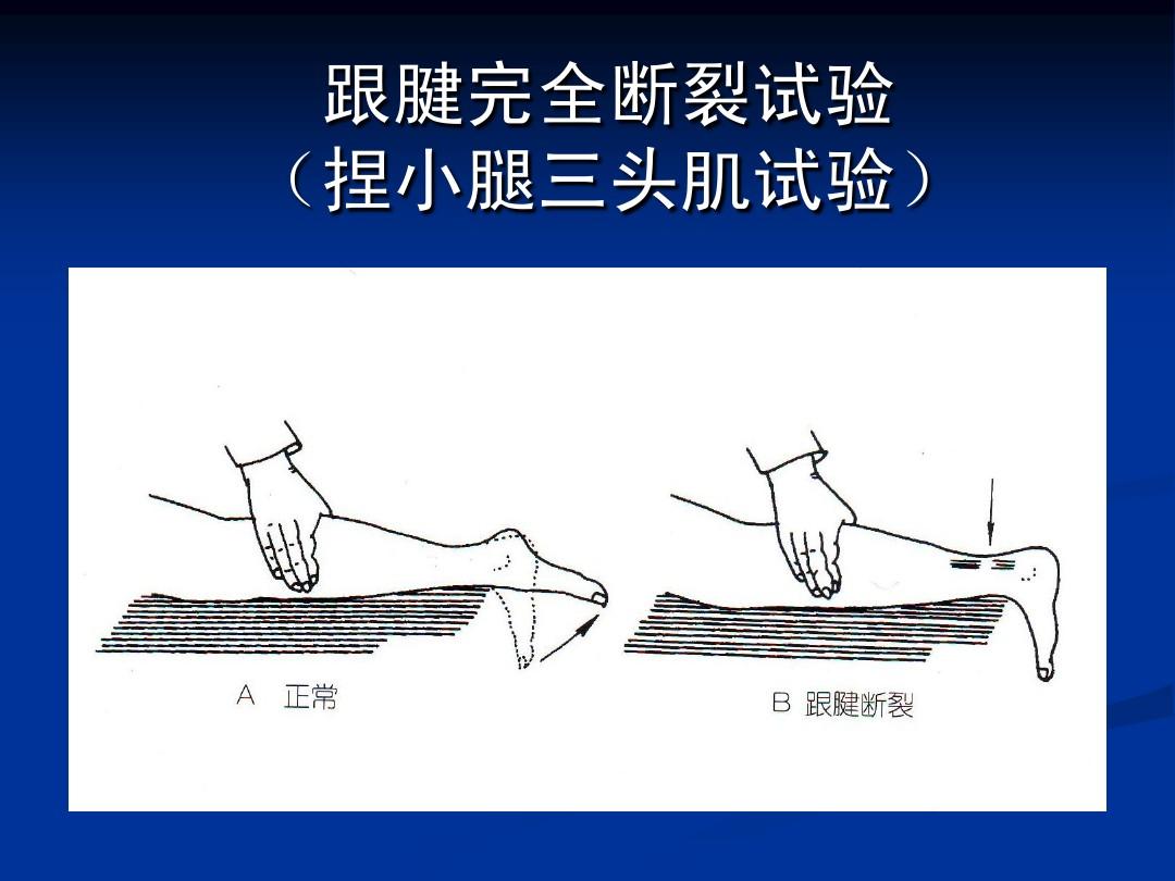 骨科医生告诉你:为什么跟腱会断?如何保护好我们的跟腱?
