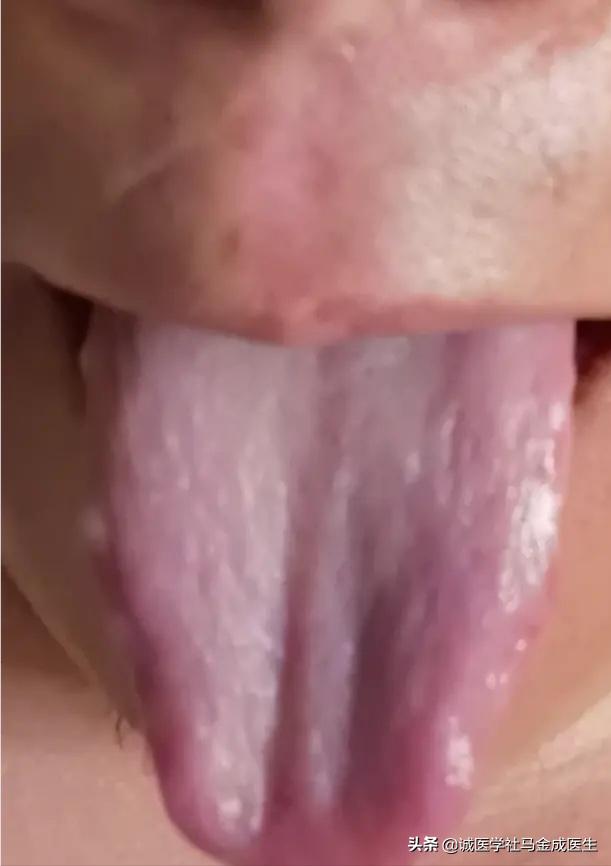 麻疹鉴别视频,荨麻疹寒热怎么治疗