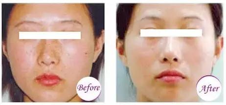 激光超皮秒祛斑后需要注意什么,激光祛斑术后注意事项有哪些