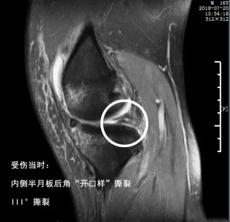 怎样能看懂膝关节核磁图片,如何看懂膝关节磁共振报告