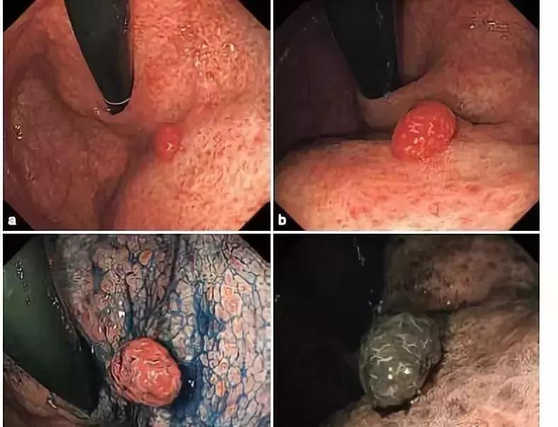 我叫“息肉”，很容易变癌，但是我最怕艾灸