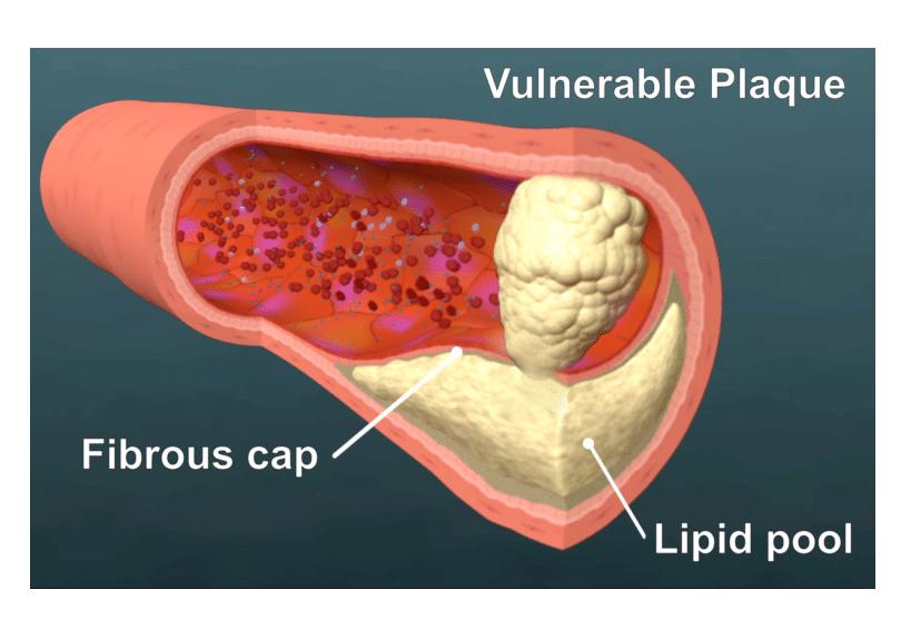 动脉粥样硬化有斑块能去除吗,体检发现动脉粥样硬化
