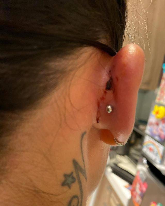 前TVB搞笑担当好身材女友耳骨连钉三个耳洞后遗症巨痛可能会溃烂