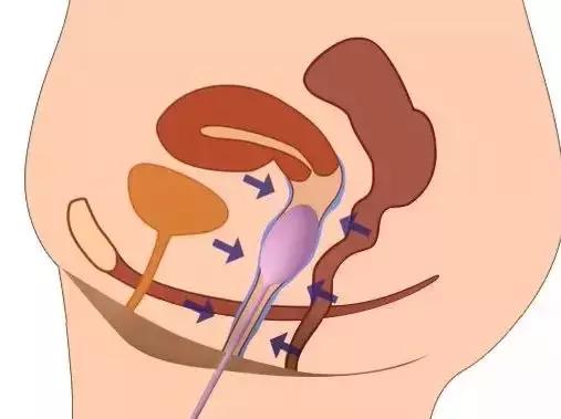 “社交癌”│车漏油开不出店门，产后漏尿走不出家门