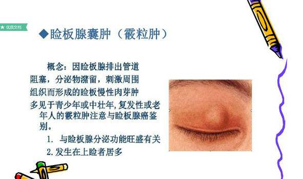 眼睛长疙瘩红肿又疼怎么办,血脂高眼睛上长疙瘩怎么办