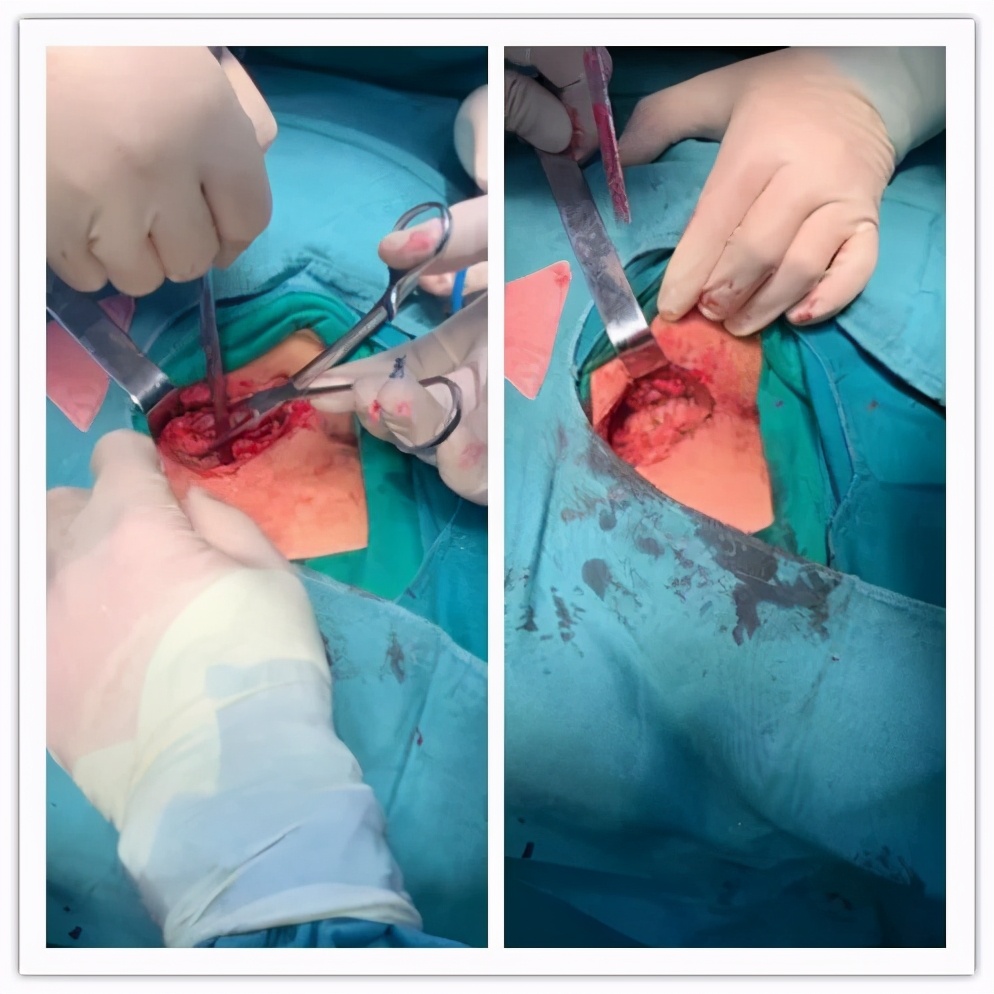 尾骨周围藏毛窦怎么治疗,藏毛窦专家问诊