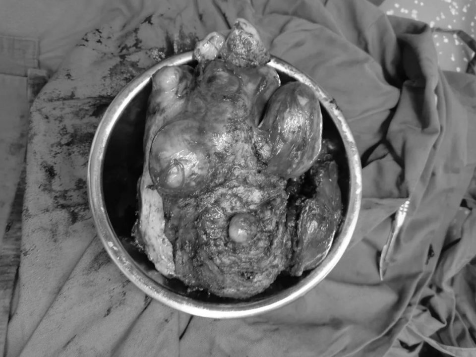 北京大兴黄村子宫肌瘤手术,大兴县医院做子宫切除多少钱