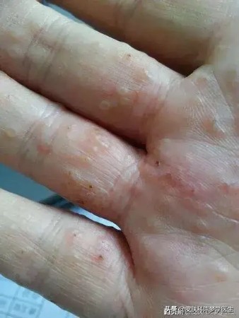 手上长密密麻麻水泡很痒涂什么药,手上起水泡脱皮瘙痒怎么回事