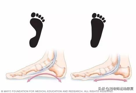 足弓塌陷、踝关节磨损、进而导致体态异常？矫正扁平足只需5步