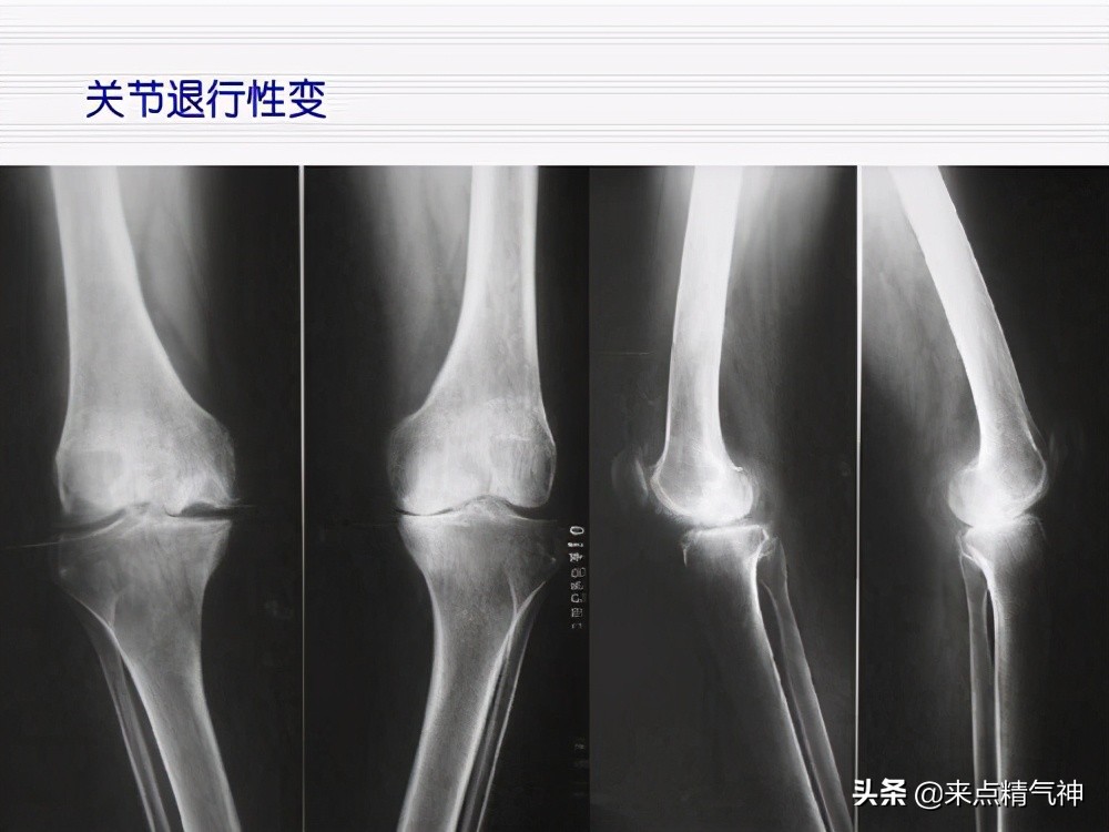 巧按摩，膝关节不再痛！关节内的软骨发生了磨损