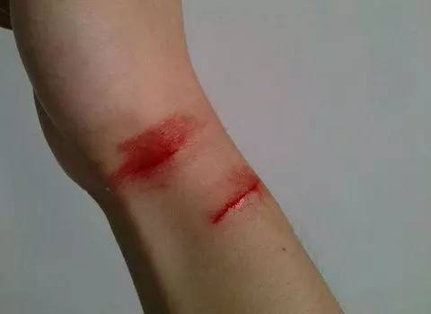 被自家养的猫咪抓伤和咬了出血了,被自己养的猫咪抓伤