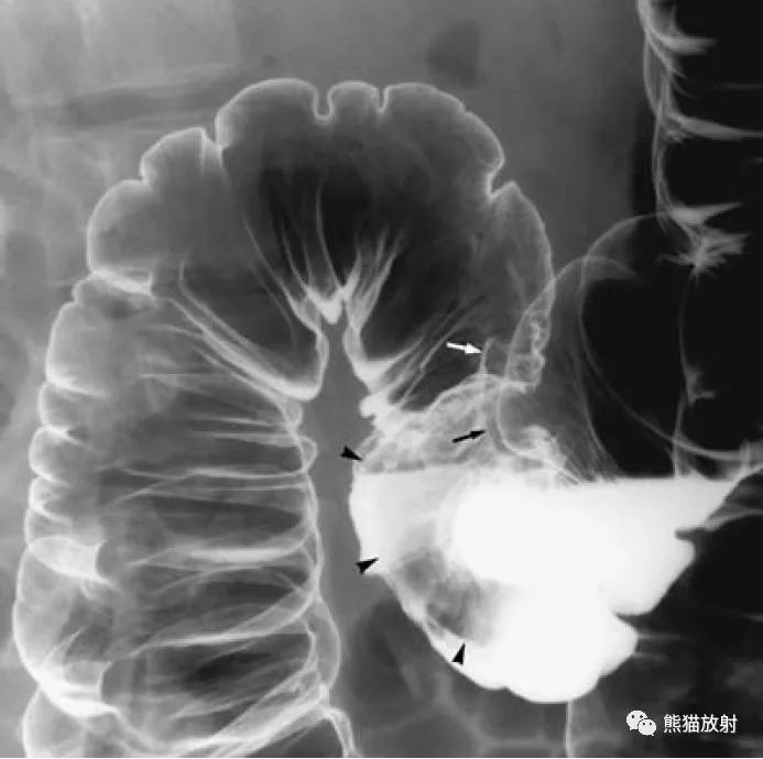 腹部影像图片大全,乙状直肠疼痛位置图片