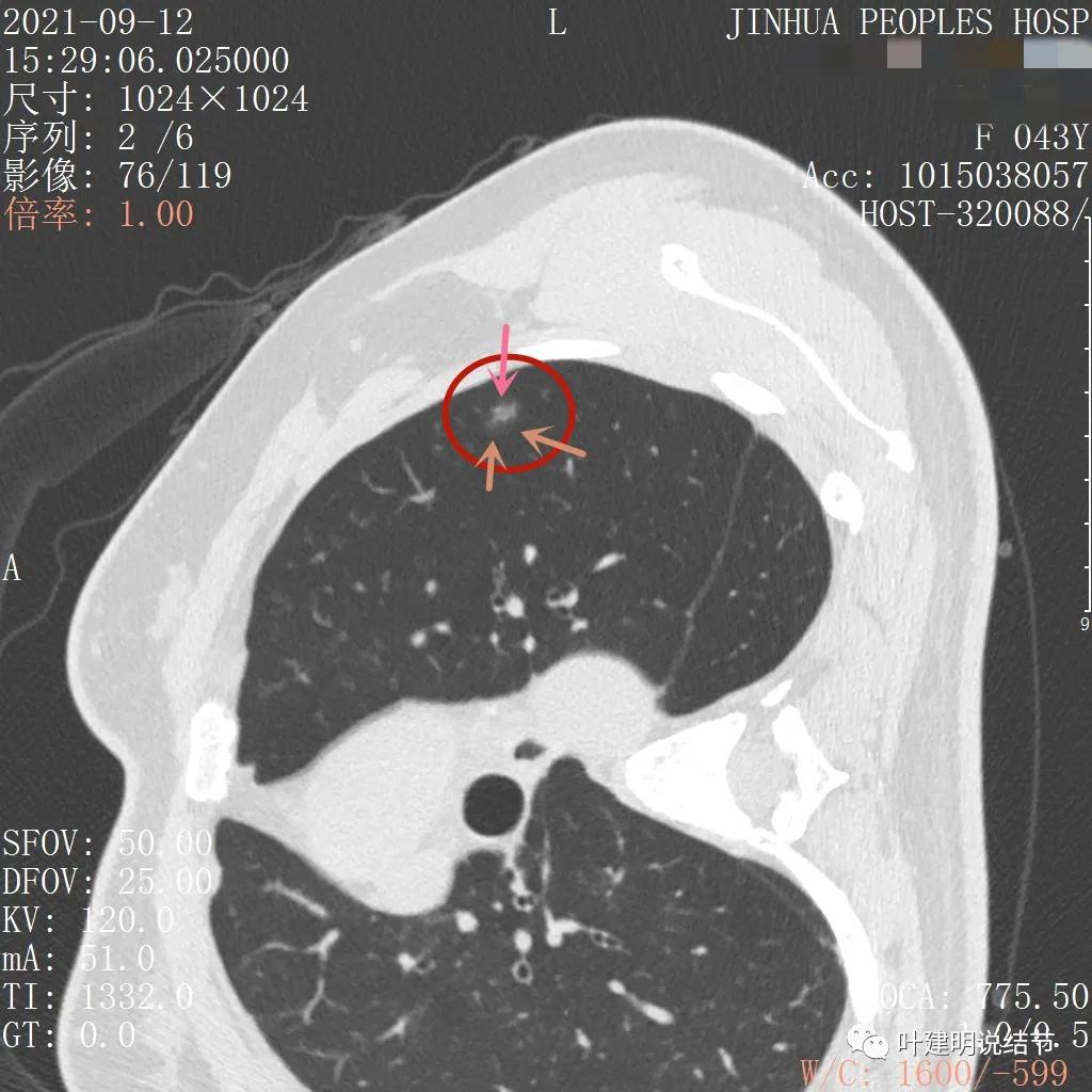 怎样从病理报告看是不是原位癌,原位腺癌切除子宫要开刀吗