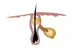 9岁女孩鼻子上长黑头怎么去除,小女孩鼻子上的黑头怎么去除