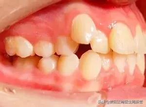 12岁前必须解决的错颌畸形,孩子十二岁牙畸形怎么办