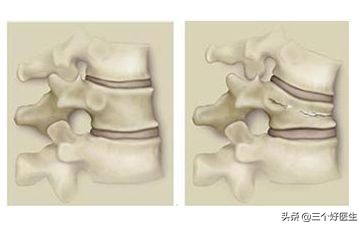 国外压缩性骨折治疗方案,压缩性骨折自愈技巧图片