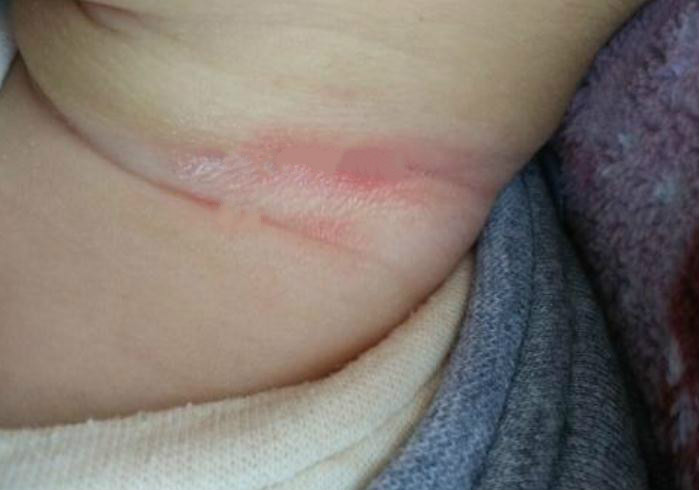 婴儿夏天脖子淹红抹什么,宝宝夏天淹脖子擦什么