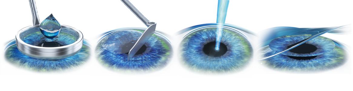 近视眼激光手术有风险吗,激光近视眼手术十大危害