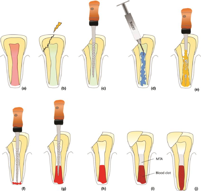 牙髓坏死还做根管治疗吗,牙髓坏死了需要取出来吗