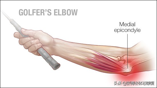 运动肘关节常见创伤及治疗方法,怎么预防肘关节康复二次损伤