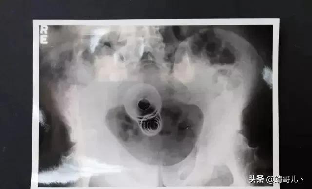 150年来从人体内取出的各式物品