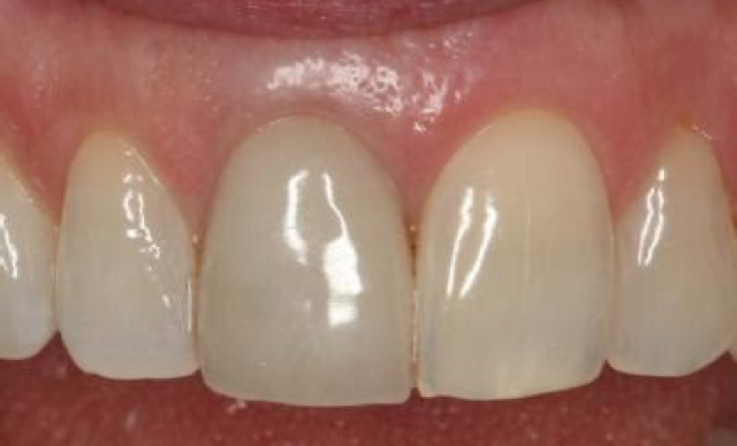 上门牙掉了一块怎么修复,牙磕碰掉了一小块怎么修复