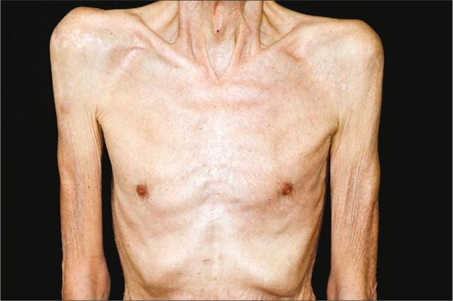 癌症怎么转移的,癌症是如何转移的