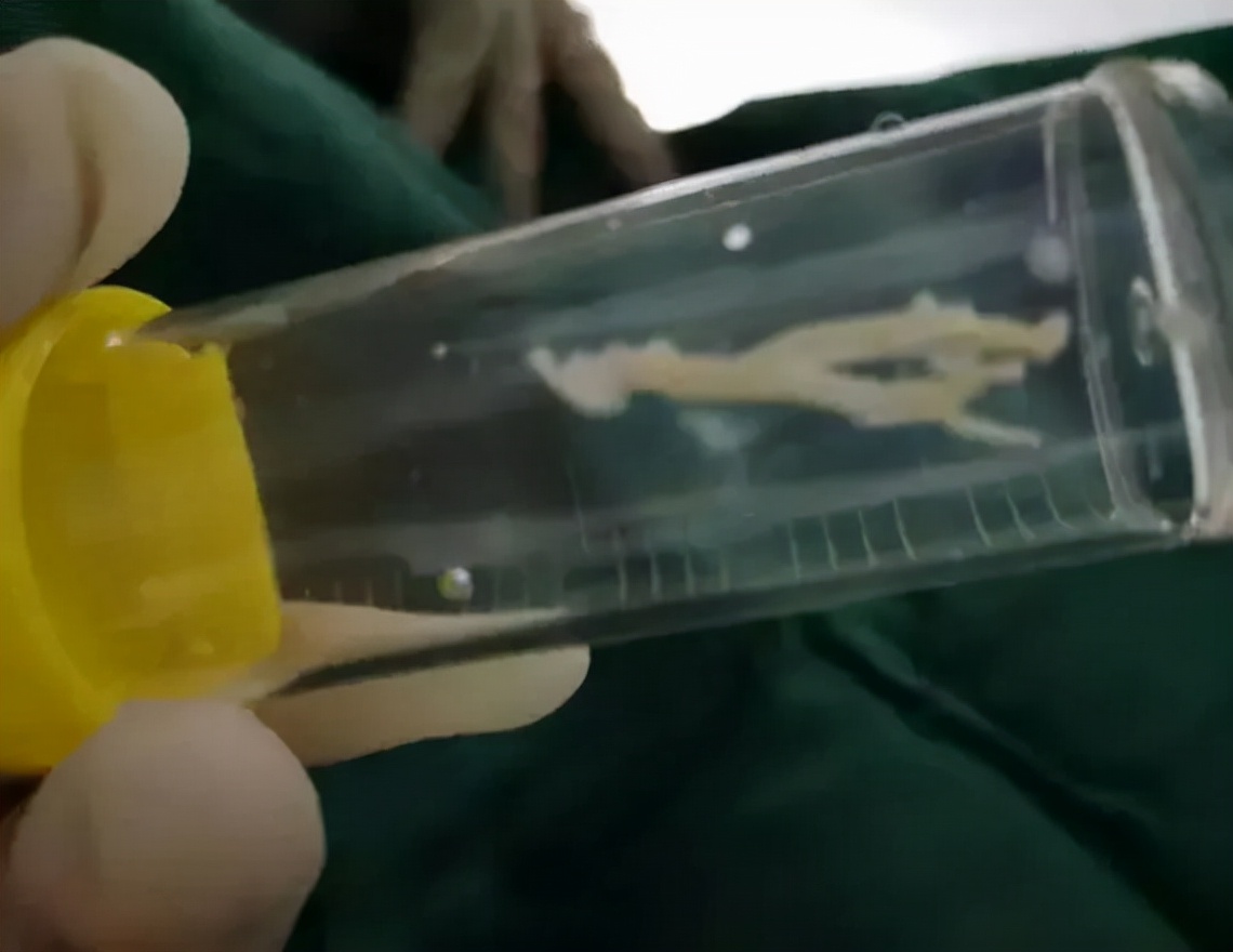 小孩肺炎支气管镜洗肺过程,肺炎总是不好怎么办