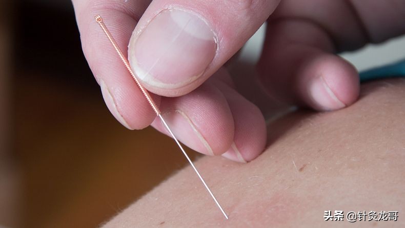 针灸疗法可以治疗哪些疾病,针灸特殊穴位有哪些