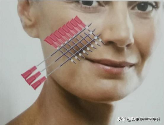 年龄大了想祛法令纹又不想动刀,泪沟法令纹不用动刀就能掩盖掉