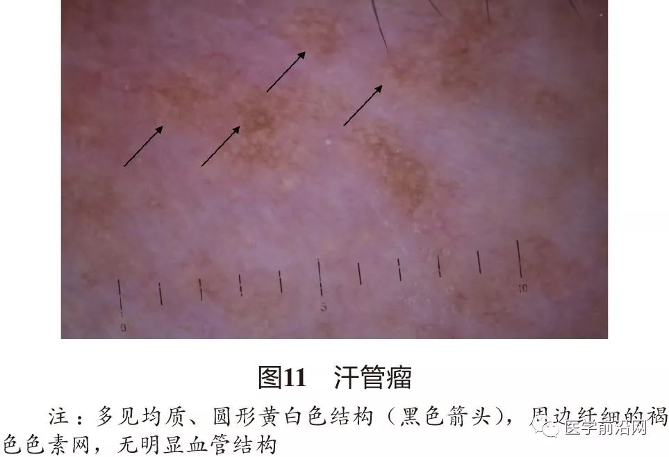 面部常见皮肤病皮肤镜诊断专家共识全文发布