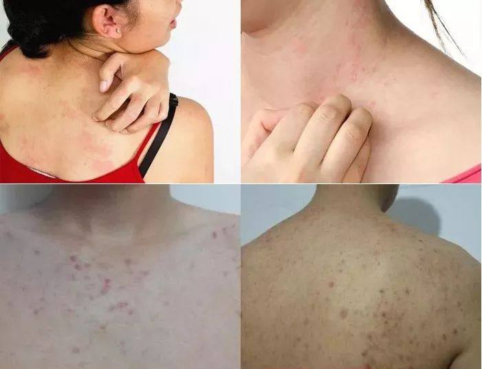 白天身上螨虫多是什么症状,身上螨虫多影响护肤吗