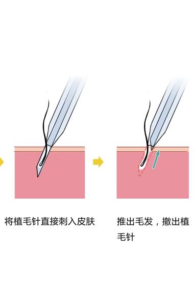 头发种植手术是如何种植的,头发种植利弊有哪些呢