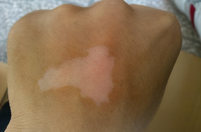 吃中药治疗白癜风的副作用,白癜风能用中药彻底治好吗