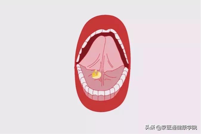 速效救心丸和硝酸甘油哪个更救命,速效救心丸和硝酸甘油保命用哪个