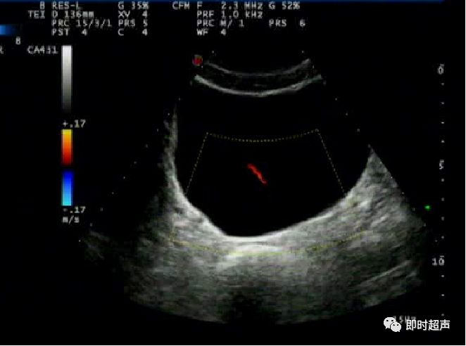 膀胱超声图解大全,膀胱超声解剖及常见病变超声表现