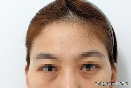 去眼袋做不做眶隔脂肪释放,眶隔脂肪释放和内切去眼袋过程