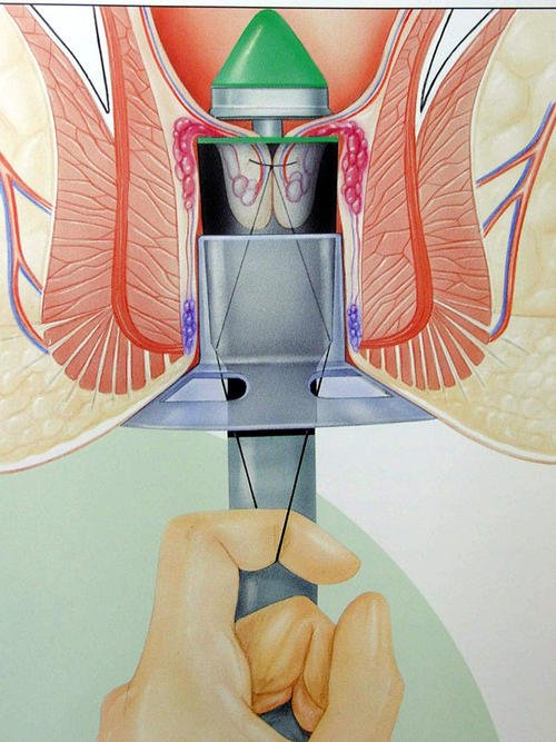 痔疮该怎么治疗？肛肠科朱医生答疑系列之二
