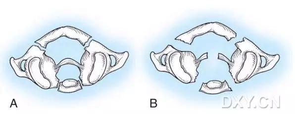 特殊骨折类型,特殊骨折体征