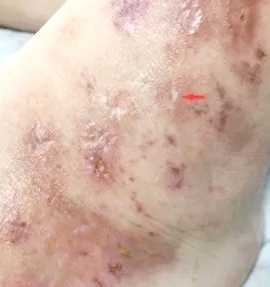 小腿上一条一条黑印什么原因,小腿上长了黑印是什么原因