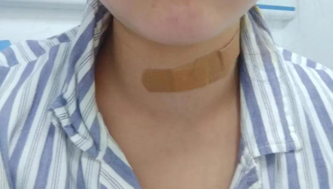 真实案例：甲状腺全切术后不仅留下“自杀式”切口，又出现感染