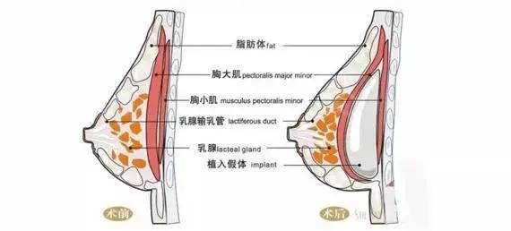 什么是乳腺纤维腺瘤？摸到乳房上有肿块，还不痛，就要小心了