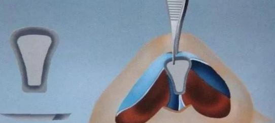 隆鼻方法,隆鼻比较好的方法