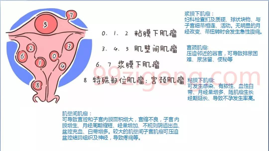 子宫有息肉又有肌瘤需要做手术吗,子宫粘膜下肌瘤可以不做手术吗