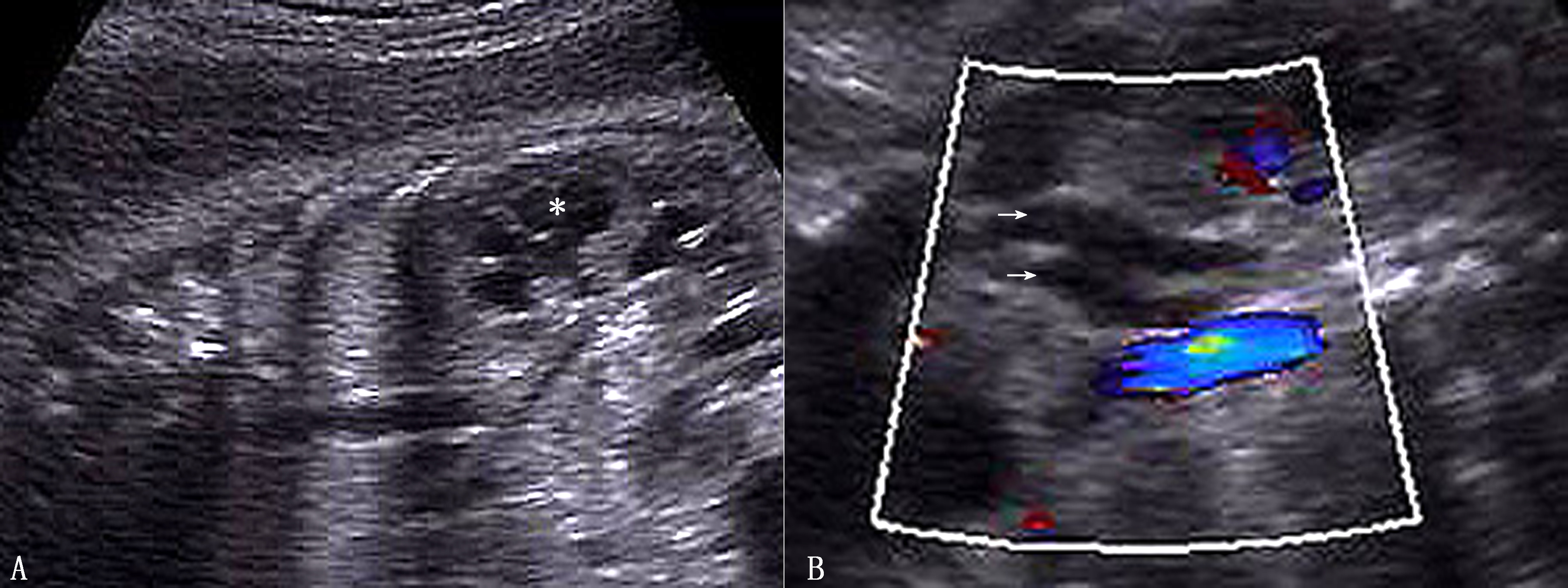 胎儿右肾发育不良是不是属于畸形,胎儿泌尿系统畸形超声表现