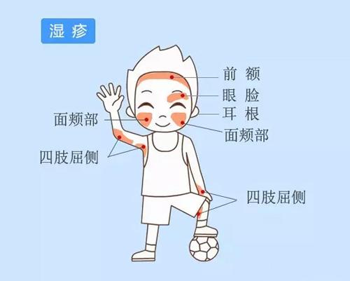 得了湿疹注意事项,得了湿疹偏方