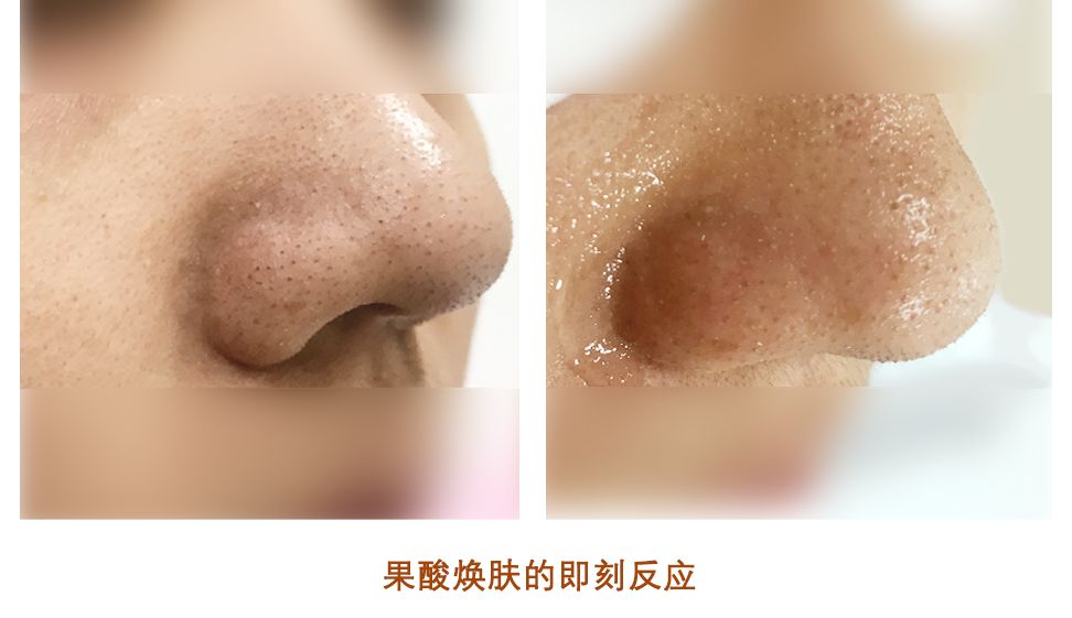 还在为粉刺黑头烦恼吗,还在为黑头而烦恼吗