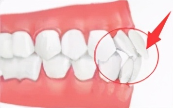 突嘴正颌手术有哪些风险,正颌手术凸嘴3d动画演示