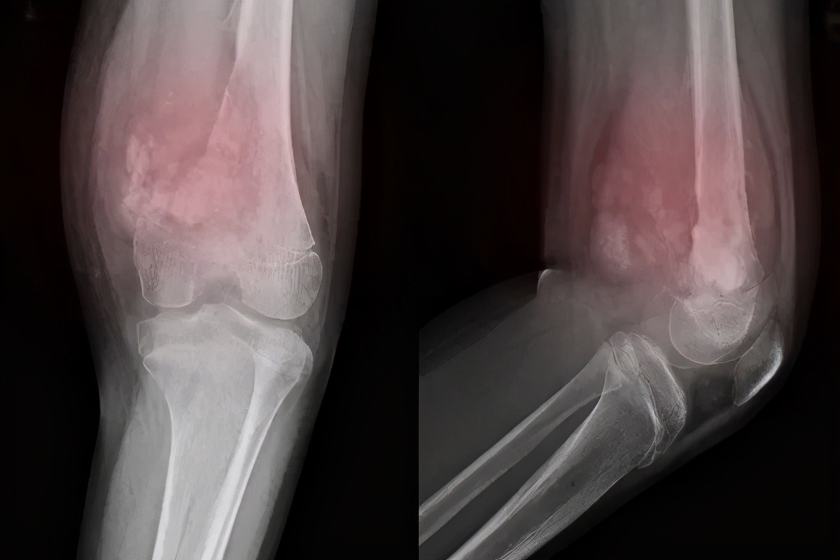 骨的新陈代谢影响因素,骨代谢都有什么症状能治疗吗